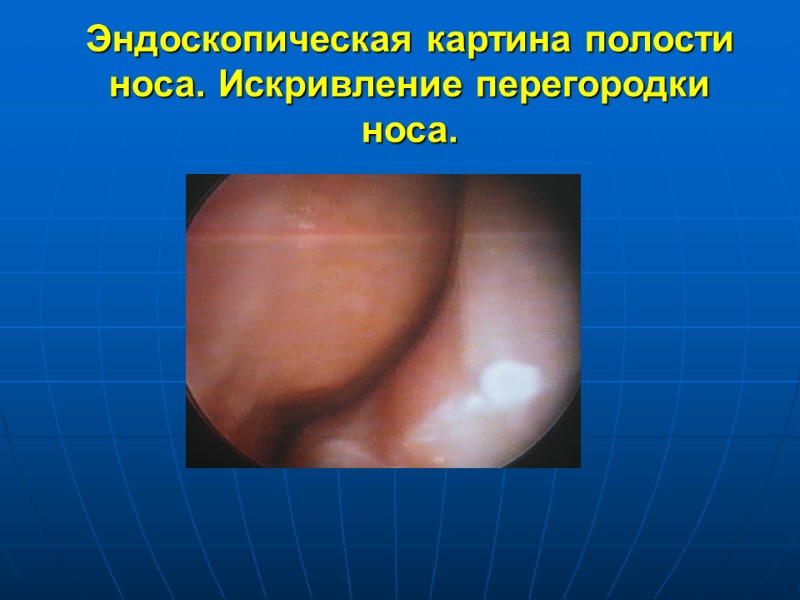 Эндоскопическая картина полости носа. Искривление перегородки носа.